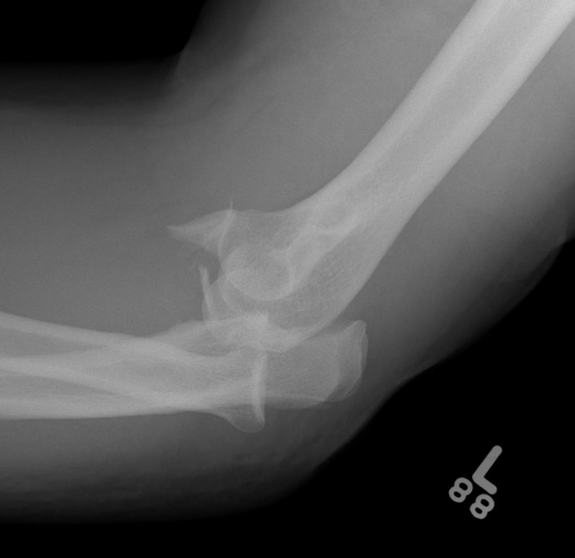 Elbow Dislocation Large Coronoid Fragment